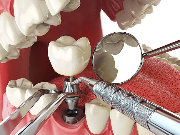Best Emergency Dental Care for Broken or Chipped Teeth in Pierceton, IN